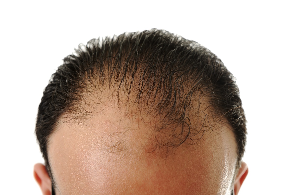 man losing his hair
